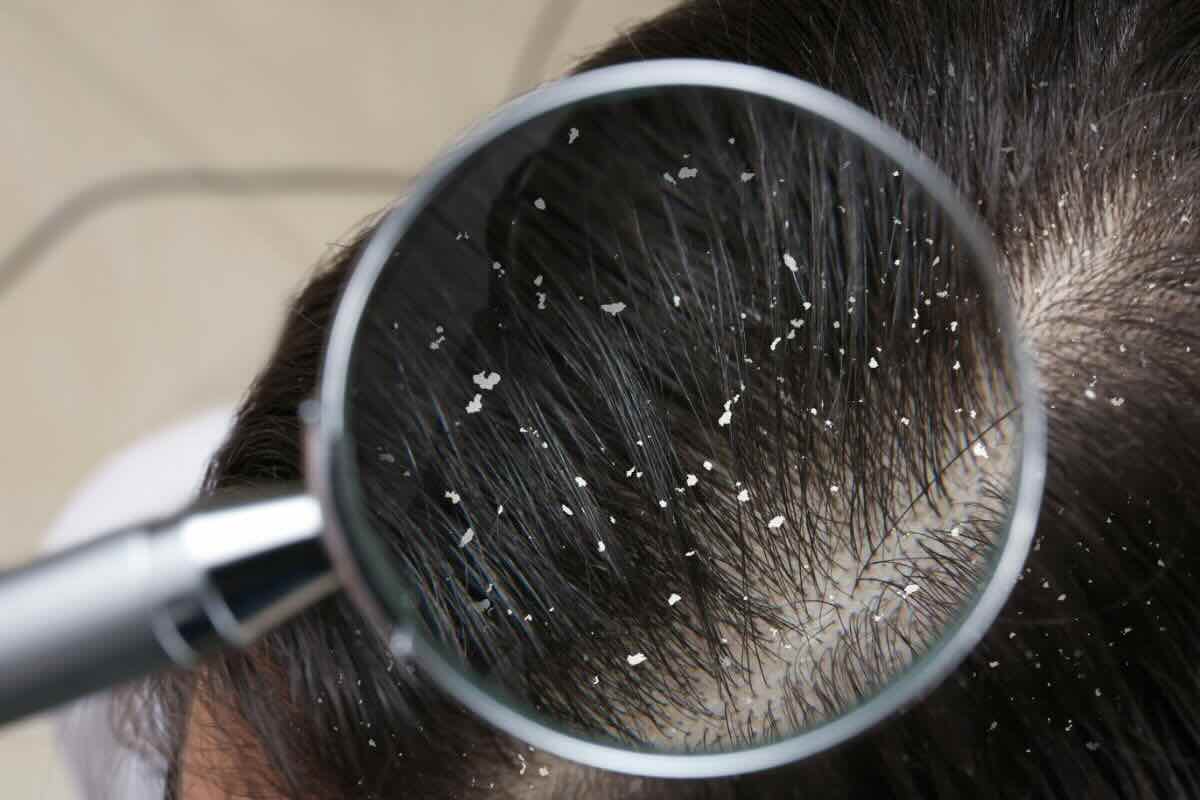 Forfora nei capelli, lente di ingrandimento